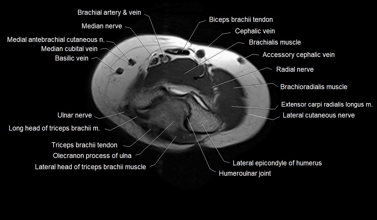 MRI 3T forearm axial cross sectional anatomy image 2.webp